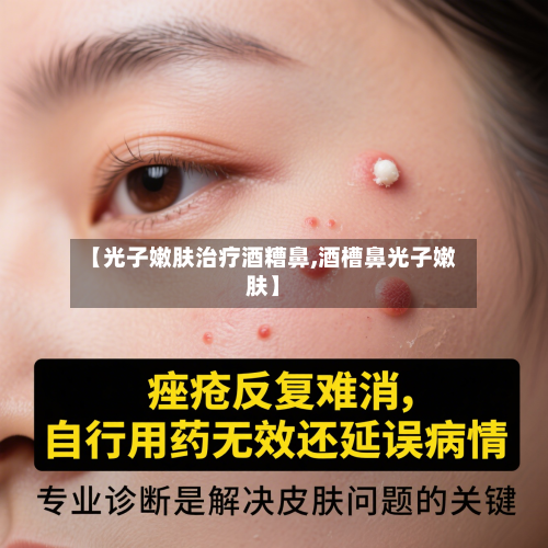 【光子嫩肤治疗酒糟鼻,酒槽鼻光子嫩肤】-第3张图片
